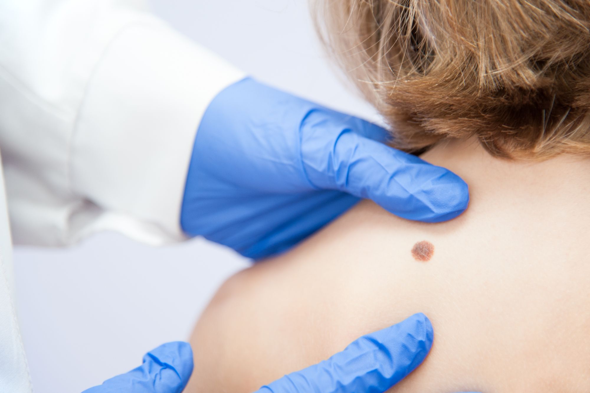 How to Talk to Your Dermatologist About Concerns of Skin Cancer