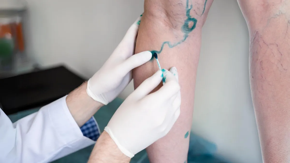 Process for Treating Varicose Veins